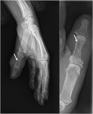 Osteolytic lesion in the proximal phalanx of the thumb.