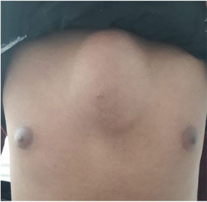 A mass over manubrium sterni.