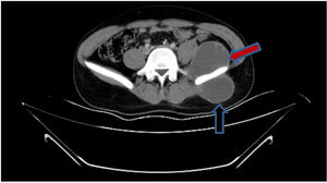 Abdominal scan demonstrating a psoas abscess (red arrow) and a gluteal abscess (black arrow).