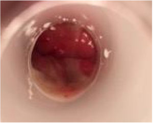 Acute proctitis: purulent discharge inside the rectum and slight oedema of the rectal mucosa.