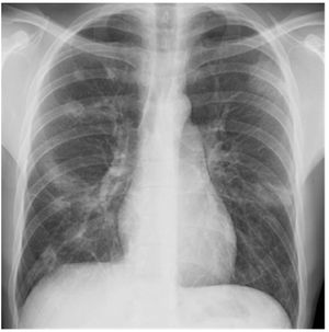 Chest X-ray on admission. Multiple nodular infiltrates can be seen.