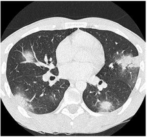Chest CT showing nodular consolidation in both lungs.