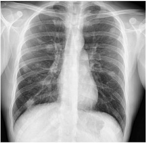 Chest X-ray. Pattern of pulmonary infiltrates different from previous images.