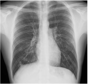 Follow-up chest X-ray. Resolution of pulmonary infiltrates.