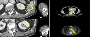 Joint CT and PET-CT study performed following endocarditis protocol after inconclusive result by transoesophageal echocardiogram by administration of intravenous contrast and 18-FDG, with imaging from the cervical region up to and including the pelvis. Hypodense lesions of triangular morphology and new appearance in the lower pole of the spleen and interpolar region of the left kidney, compatible with small infarcts (yellow circles). Focal increase in metabolic activity (yellow line) on the prosthetic aortic valve annulus's anterior region makes it impossible to rule out endocarditis without significant morphological findings.
