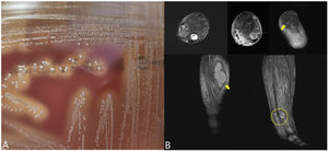 A) β-haemolytic colonies on TSA agar with 5% sheep blood (24h incubation, 5% CO2). B) Collection in the posterior aspect of the leg (diameters of 8×5×2cm) compatible with abscess (lower arrow), pretibial collection (1.7cm) in the middle third and other collections at the distal level (circle). Collection in the region of the joint in relation to the tendon and flexor sheath of the big toe of 2cm (upper arrow). Signs of renal alteration were also observed in relation to osteitis or incipient osteomyelitis in the external malleolus, in relation to the course of the screws removed along 10cm and with diffusion coefficient restriction, in both cases abscessed.