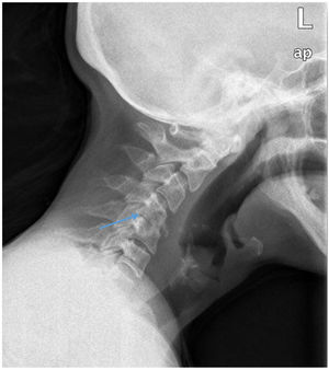 Lateral neck X-ray. Height loss can be seen between spaces C4 and C5.