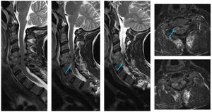 Magnetic resonance imaging of the neck: coronal and transverse sections. C4–C5 spondylodiscitis and epidural abscess between C4 and C6 (arrow) can be seen.