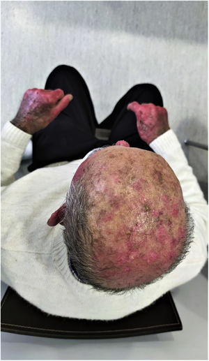 First- and second-degree burns on the scalp.