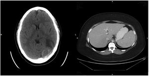 Left. Brain CT shows hyperdensity of the left transverse sinus associated with posterior temporal infarction with haemorrhagic transformation. Right. Abdominal CT reveals a non-occlusive thrombus in the portal vein.