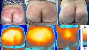 Clinical and thermographic monitoring of the progression of skin and soft tissue infection on days 0, 2 and 7 of treatment with amoxicillin-clavulanate.