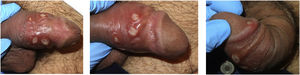 Multiple syphilitic chancres. Eight superficial ulcers with a fibrin base and raised borders.