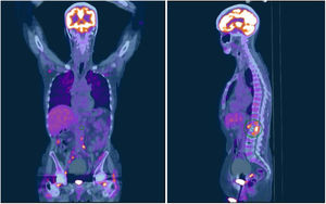 PET-CT coronal and sagittal slices, respectively.