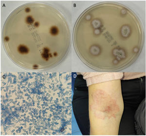 Figure 1 A-B) Reverse-front aspect of the colony on Sabouraud agar. C) Two-cell macroconidia with lactophenol cotton blue (40⋅) at 14 days (potato agar). D) Skin lesion on the arm and ulnar fold.