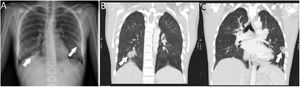 Chest X-ray (A): pulmonary condensations with a tendency to cavitation. Coronal reconstruction of the CT (B and C) with lung window that facilitates better definition of the lesions, with cavitation in the left lower lobe.