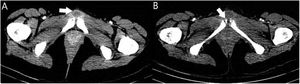 Pelvic CT with intravenous contrast revealed a collection dependent on the pubic symphysis (A), as well as bone irregularity of the adjacent pubic rami (B).