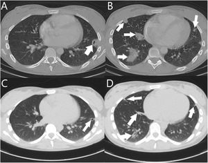 Axial chest CT images: improved radiological findings with involution of pulmonary condensations on admission (A and B) compared to after antibiotic therapy (C and D).