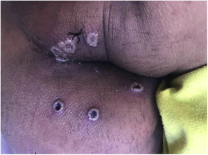 Perianally-dispersed pustular and ulcerated lesions with a necrotic centre and raised edges.