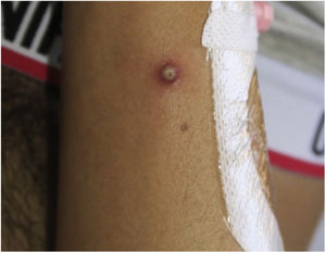 Isolated pustule on the upper limb and perilesional erythema.