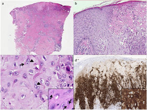 a) Skin showing an ulcerated area; b) The epidermis showing mild acanthosis, mixed-type exocytosis and debris; c) “ballooned” keratinocytes, with multinucleation (with 2 and 3 nuclei — arrowheads). A “basophilic halo” is observed in the nucleus of some keratinocytes. In greater detail Guarnieri bodies (indicated with arrows); d) Vaccinia immunohistochemistry.