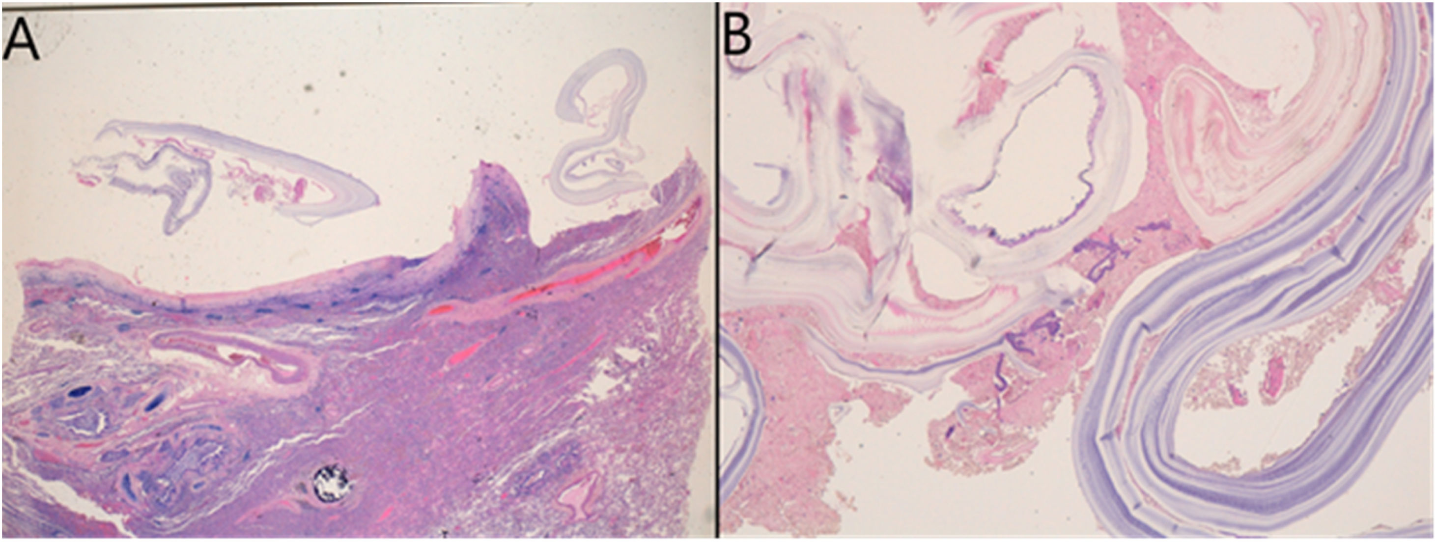 Chronic cough in an immigrant patient | Enfermedades Infecciosas y ...