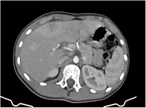 Computed tomography of abdomen. Liver lesions with arterial phase enhancement.