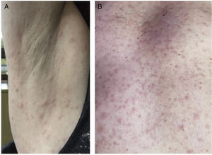 (A) Case 1. 42-year-old woman with maculopapular rash in the right axilla. (B) Case 2. 63 year-old male with papular rash in the chest/abdominal area.