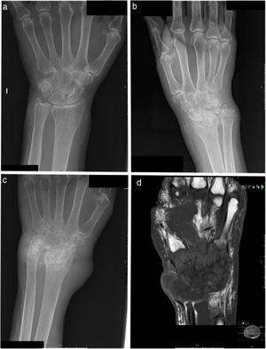 (A) Normal X-ray. (B) X-ray of bone showing polyarthritis at the carpus and radiocarpal joint; joint with synovial calcifications. (C) Follow-up bone X-ray eight months after image B; progression of joint damage can be seen, with bone involvement suggesting osteomyelitis. (D) Magnetic resonance imaging. T1-weighted image with contrast shows widespread severe damage in all carpal bones, distal ulna and radius and second to fifth metacarpals, as well as synovial thinning in all carpal joints, with a heterogeneous fluid collection on the dorsal aspect of the wrist.