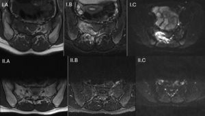 I: Lumbosacral MRI at diagnosis. Axial slice at S1, sequences I.A) T1, I.B) STIR, I.C) DWI. II: Lumbosacral MRI after three months of antibiotic therapy. Axial slice at S1, sequences II.A) T1, II.B) STIR, II.C) DWI. T1: longitudinal relaxation time; STIR: Short time inversion recovery; DWI: Diffusion-weighted Image.