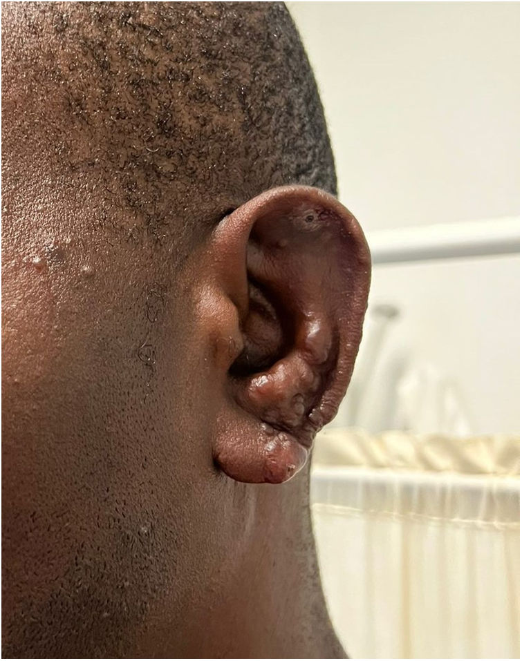 Lobulo Infectado Are these lesions contagious? | Enfermedades Infecciosas y ...