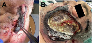 (A) Necrotic plaque in the left malar region with two points of spontaneous oozing observed on physical examination of the patient in the Accident and Emergency department. (B) Image of the lesion prior to surgical debridement.