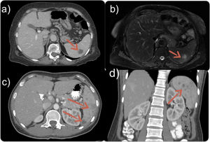 a) Case 1: Abdominal computerised tomography (CT), sagittal section. Hypodense splenic lesion; b) Case 1: Abdominal magnetic resonance imaging, T2-weighted sequence. Hyperintense splenic lesions with perilesional oedema; c) Case 2: Abdominal CT, sagittal section. Hypodense and heterogeneous splenic lesions; d) Case 2: Abdominal CT, coronal section. Hypodense and heterogeneous splenic lesions.