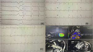 A) Initial ECG showing complete AVB with wide QRS and complete LBBB morphology. B) Changes after two weeks of antibiotic therapy, ECG with first-degree AVB and narrow QRS. C) Changes after one month of antibiotic therapy, ECG in sinus rhythm (SR) with narrow QRS. D) Cardiac MRI showing focal enhancement pattern in the inferolateral, superolateral and anteroseptal surfaces.