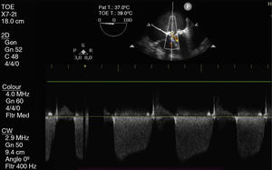 Transoesophageal echocardiogram centred on the mitral valve.