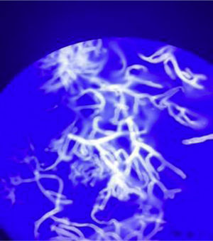 Calcofluor white staining of the prosthetic valve.