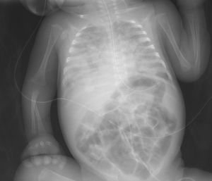 Bilateral areas of consolidation in the lungs, most prominent in the right lower lobe and middle lobe.
