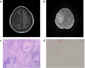 (a) and (b) CNS MRI findings. (c) Necrotizing granuloma in histologic specimen. (d) Gram stain of Brucella sp. colonies.