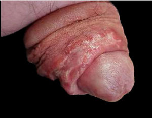 Ulceration with raised edges on the foreskin on the dorsal aspect of the penis.