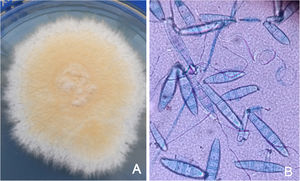 (A) Sabouraud agar culture of Nannizzia gypsea, where a powdery, beige-coloured colony can be seen. (B) Microculture with lactophenol blue showing macroconidia of Nannizzia gypsea, with four to six spindle-shaped septa with a thin membrane.
