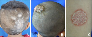 (A) Superficial variety of tinea capitis. (B) Inflammatory tinea capitis, kerion celsi type. (C) Tinea corporis resembling nummular eczema.