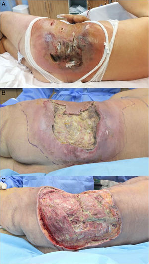 Necrosis in the left flank with extension to the gluteus: A) on arrival at our hospital. B) after the first surgical intervention, and C) after the extensive surgical intervention performed 10 days after admission following the histopathological finding of invasive fungal infection.