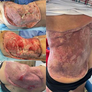 A) Coverage defect in the left flank and gluteus, prior to starting grafts one month after admission; B) one week after the start of grafting with incipient epithelialisation; C) 4 months after admission, 2 months after discharge, and D) 6 months after discharge, approximately 1 month after the end of posaconazole.