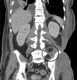 Computed tomography obtained in the month two of admission, compatible with collection/abscess adjacent to left iliac blade. Note the large cutaneous/subcutaneous defect on the patient
