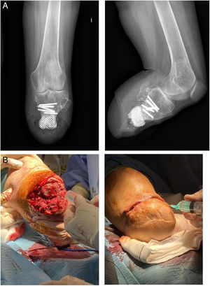 (a) Radiological image of the PJI. (b) Intrasurgical phage administration.