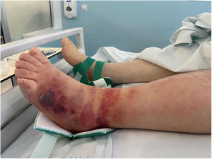 Left leg with significant oedema, erythema and blisters 24 h after admission to the ICU.