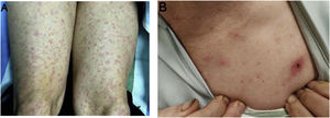 Characteristic skin manifestations of Japanese spotted fever. (A) Symmetrical rash on the lower limbs (1–3mm in diameter). (B)Typical eschar (8mm×6mm) on the anterior chest wall, featuring central necrosis with a peripheral erythematous halo, surrounded by disseminated petechial lesions.