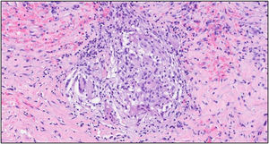 Histological section of breast tissue from the first case.