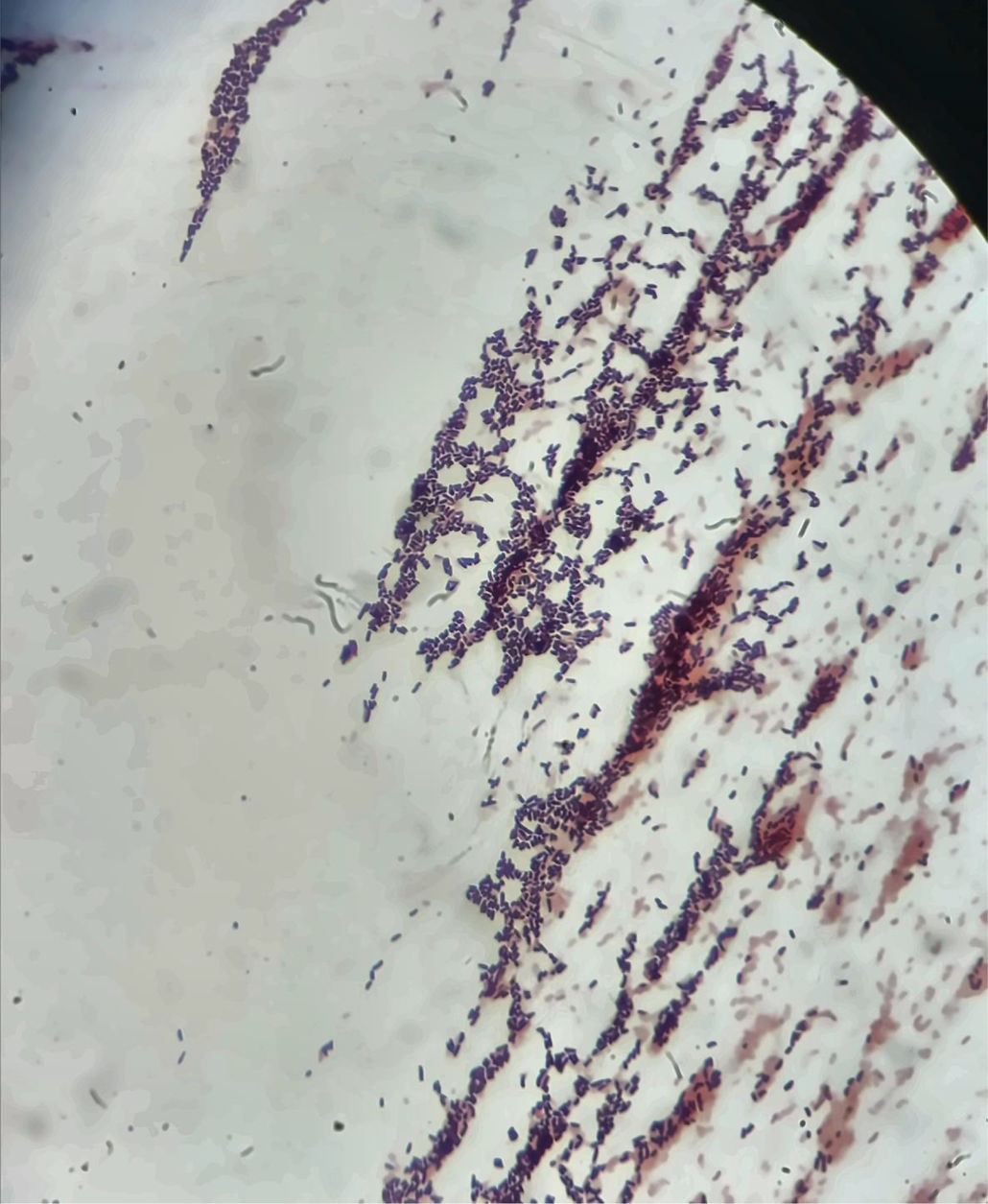 Chronic otitis media due to Auritidibacter ignavus: a two-case series ...