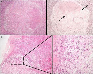 A) Hipófisis normal versus adenoma hipofisario. Nótese el patrón acinar periférico de la glándula hipofisaria anterior normal (flecha continua), en contraste con la disrupción de la red de reticulina habitual en un adenoma (flecha discontinua) (técnica histoquímica de HE –izquierda– y de Gomori-reticulina –derecha–, 40×). B) La glándula hipofisaria normal manifiesta una «invasión basófila» fisiológica durante el envejecimiento. Se observan regueros de células endocrinas basófilas que se extienden desde la interfase del lóbulo anterior hasta la neurohipófisis (HE 40×; HE 200x).