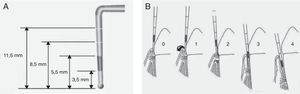 Determinación del índice periodontal comunitario. Es necesario utilizar la sonda periodontal de la OMS, que termina en bola y tiene marcada en negro la zona comprendida entre los 3,5 y 5,5mm, con 2 marcas adicionales a los 8,5 y 11,5mm (A). Cada sextante se valora de acuerdo con los siguientes códigos. 0: salud periodontal; 1: hemorragia al sondaje suave; 2: presencia de cálculo supra o subgingival, ninguna bolsa excede los 3mm; 3: bolsas de 4-5mm (banda negra de la sonda parcialmente oculta); 4: bolsas iguales o mayores de 6mm (banda negra oculta) (B).